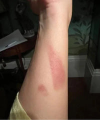 before and after problem: Acne