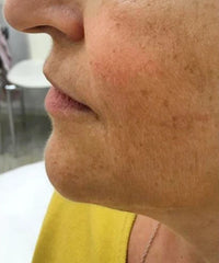 before and after problem: Acne