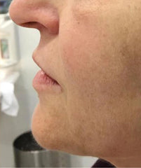 before and after problem: Acne