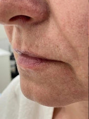 before and after problem: Acne