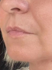 before and after problem: Acne