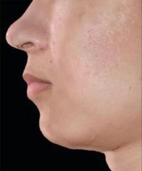 before and after problem: Acne