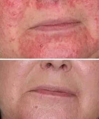 before and after problem: Acne