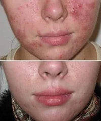 before and after problem: Acne