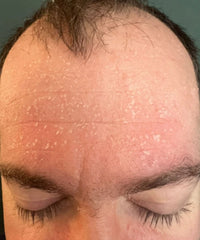 before and after problem: Acne