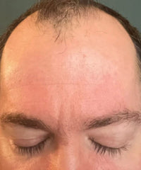 before and after problem: Acne