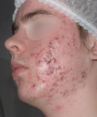 before and after problem: Acne