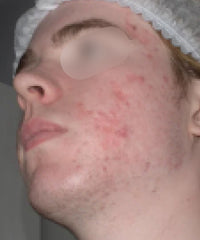 before and after problem: Acne