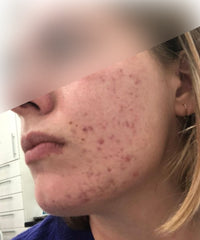before and after problem: Acne