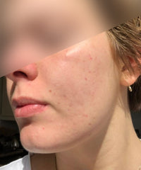 before and after problem: Acne