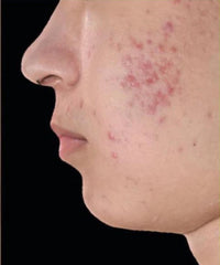 before and after problem: Acne